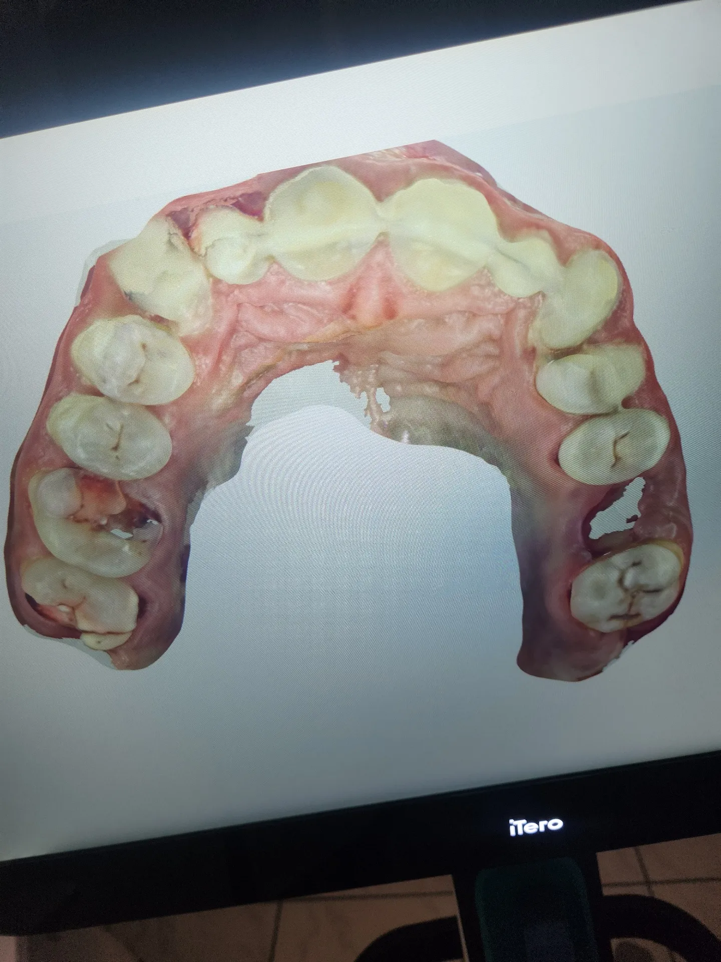 3D-Digitalabdruck des Zahnbogens mit dem iTero-Intraoralscanner, um die Situation zu analysieren und den Behandlungsplan zu erstellen.
