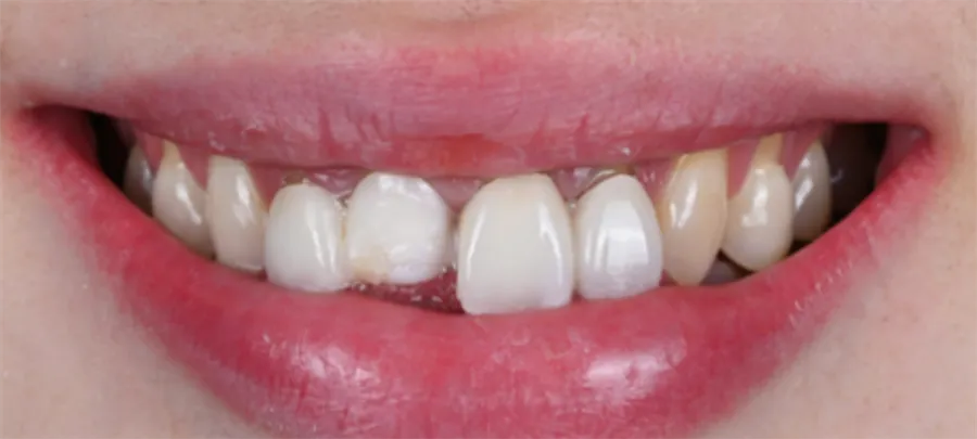 Dents à restaurer avant traitement, cas 2