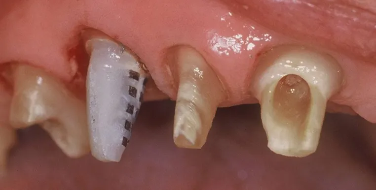 Dents délabrées avant traitement