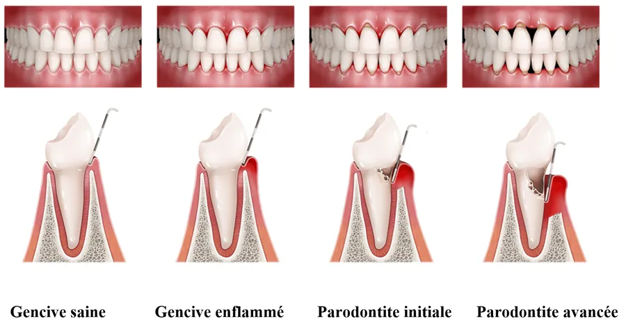 Anatomie de la gencive et du parodonte