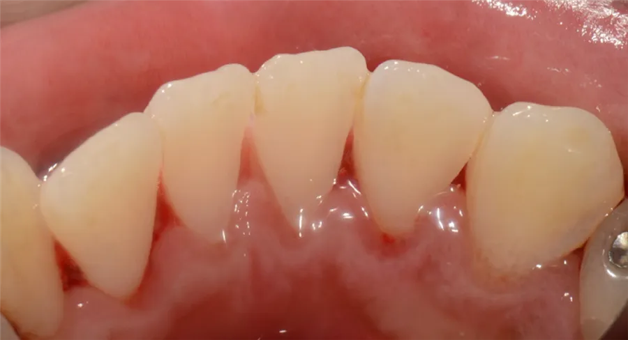 Dents et gencives après le détartrage