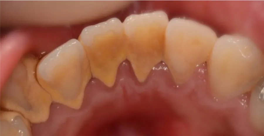 Dents et gencives avant le détartrage