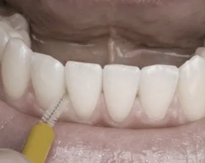 Nettoyage entre les dents à la brossette interdentaire