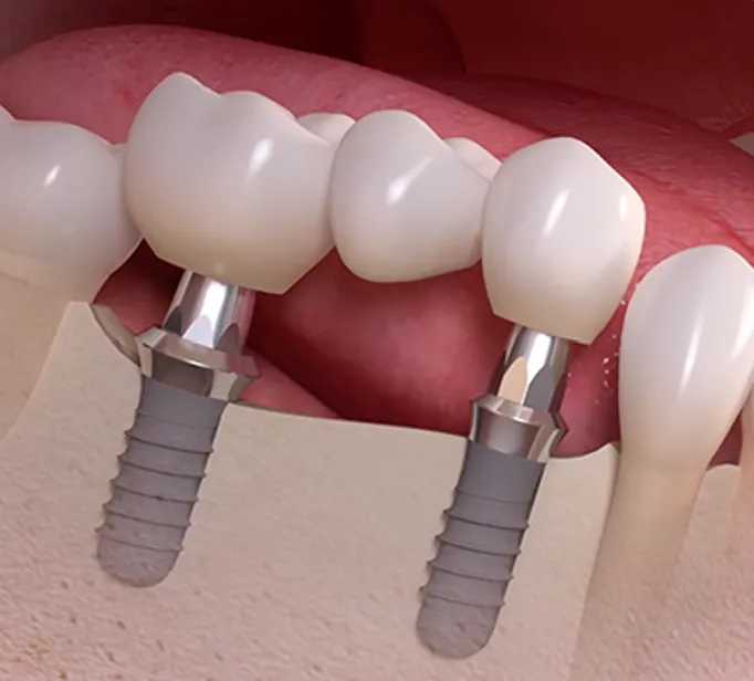 Remplacement de plusieurs dents par des implants