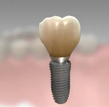 Positionnement de l’implant à l’aide d’un guide