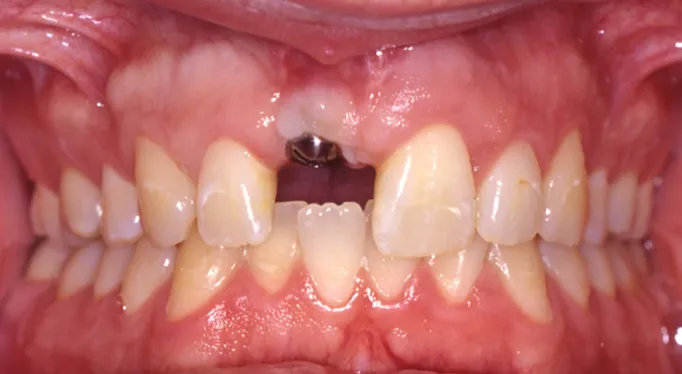 Chirurgie d’implantation d’une dent