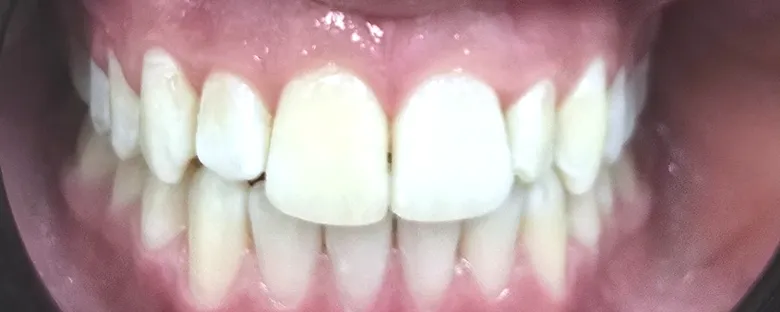 Schliessen eines Diastemas mit Invisalign · Nachher