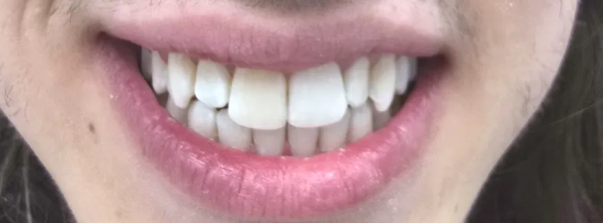 Schliessen eines Diastemas mit Invisalign · Nachher