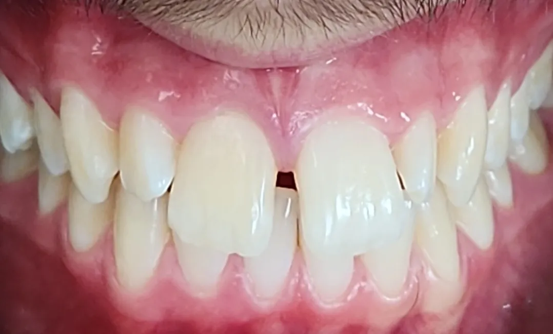 Schliessen eines Diastemas mit Invisalign · Vorher