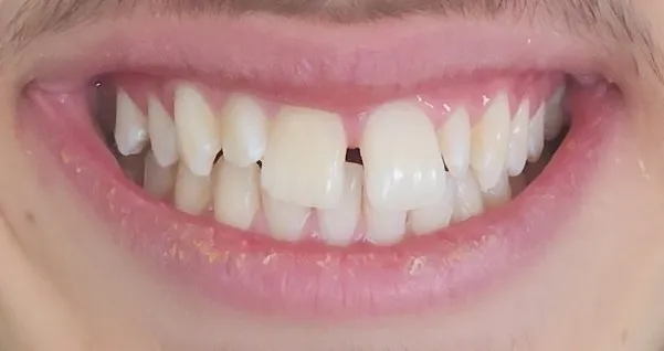 Schliessen eines Diastemas mit Invisalign · Vorher