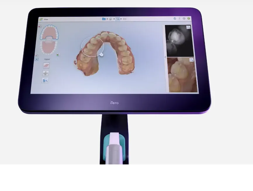 Der iTero-Scanner zeigt den digitalen 3D-Abdruck eines Zahnbogens.