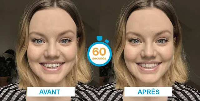 Illustration du traitement Invisalign